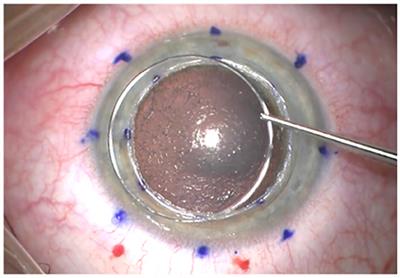 A New Pre-descemetic Corneal Ring (Neoring) in Deep Anterior Lamellar Keratoplasty for Moderate-Advanced Keratoconus: A Pilot 2-Year Long-Term Follow-Up Study